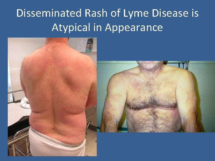 Disseminated Rash of Lyme Disease is Atypical in Appearance 