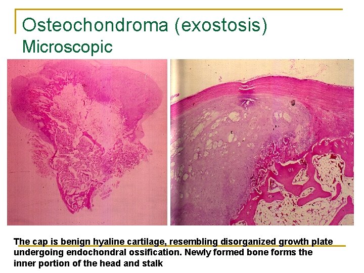Osteochondroma (exostosis) Microscopic The cap is benign hyaline cartilage, resembling disorganized growth plate undergoing