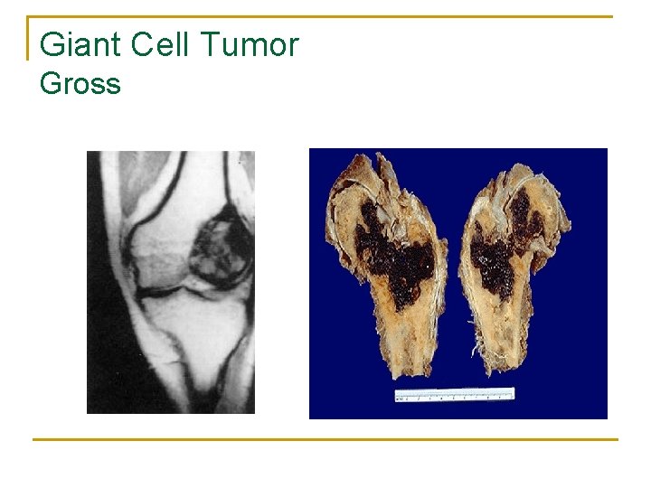 Giant Cell Tumor Gross 