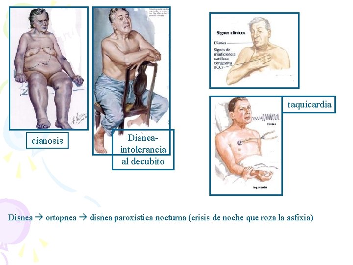 taquicardia cianosis Disneaintolerancia al decubito Disnea ortopnea disnea paroxística nocturna (crisis de noche que