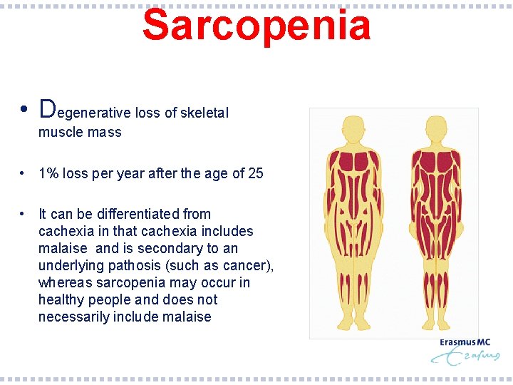 Sarcopenia • Degenerative loss of skeletal muscle mass • 1% loss per year after