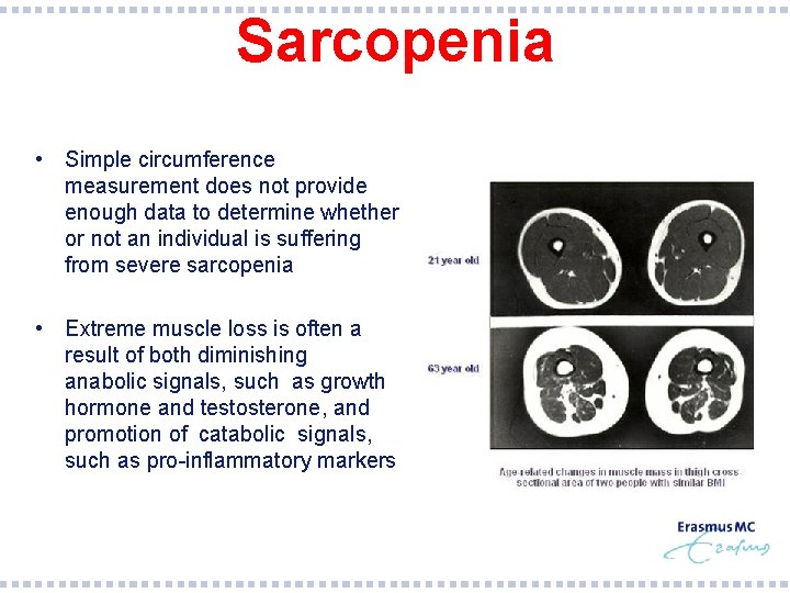 Sarcopenia • Simple circumference measurement does not provide enough data to determine whether or