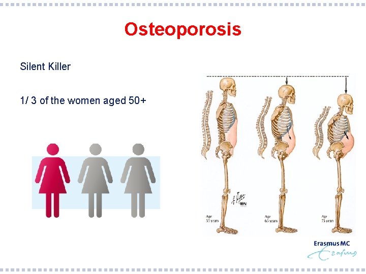 Osteoporosis § Silent Killer § 1/ 3 of the women aged 50+ 