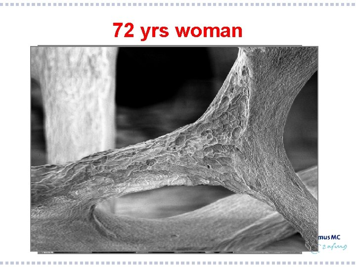 72 yrs woman 0. 2 mm 