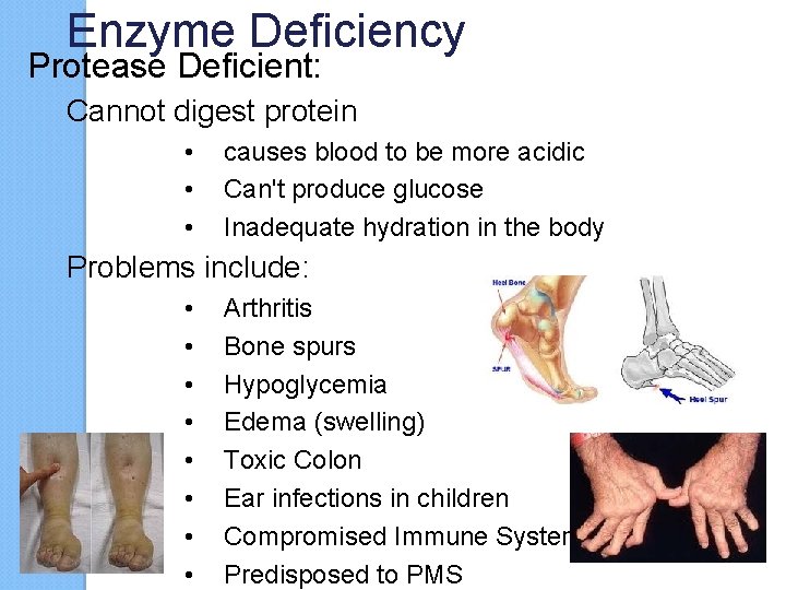 Enzyme Deficiency Protease Deficient: Cannot digest protein • • • causes blood to be