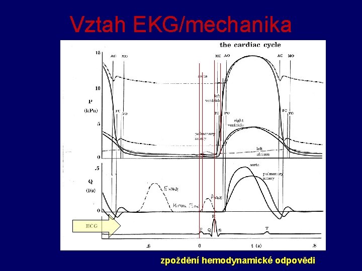 Vztah EKG/mechanika zpoždění hemodynamické odpovědi 