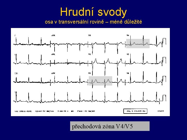 Hrudní svody osa v transversální rovině – méně důležité přechodová zóna V 4/V 5