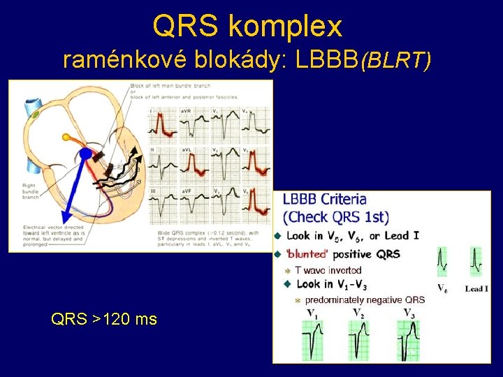QRS komplex raménkové blokády: LBBB(BLRT) QRS >120 ms QRS komplex raménkové blokády: LBBB(BLRT) QRS >120 ms