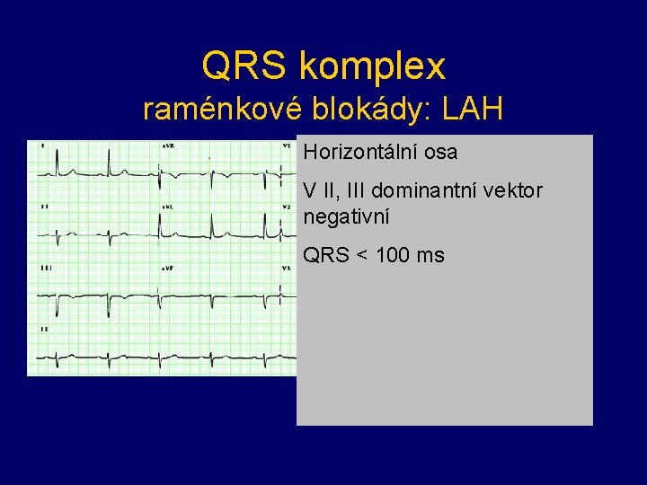 QRS komplex raménkové blokády: LAH Horizontální osa V II, III dominantní vektor negativní QRS