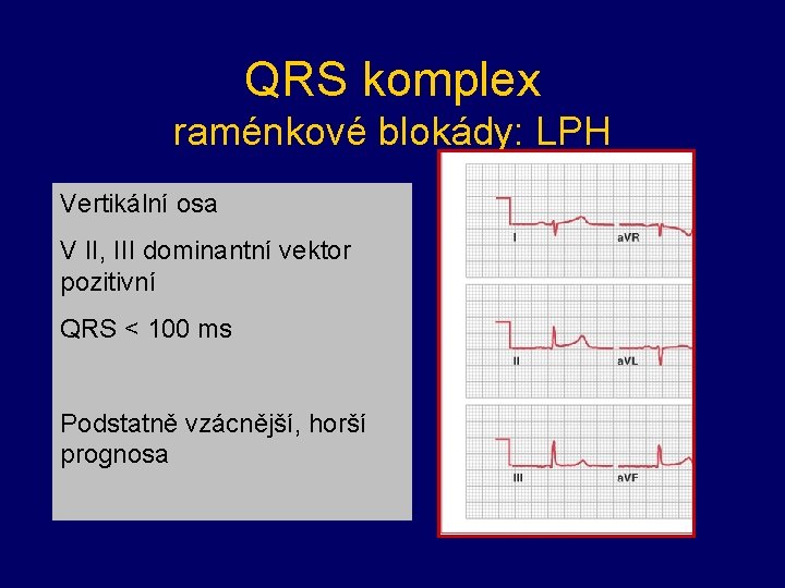 QRS komplex raménkové blokády: LPH Vertikální osa V II, III dominantní vektor pozitivní QRS QRS komplex raménkové blokády: LPH Vertikální osa V II, III dominantní vektor pozitivní QRS