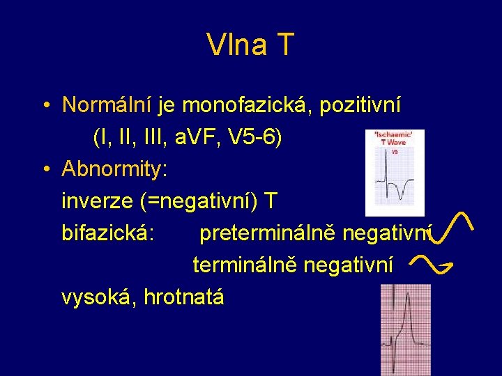 Vlna T • Normální je monofazická, pozitivní (I, III, a. VF, V 5 -6)
