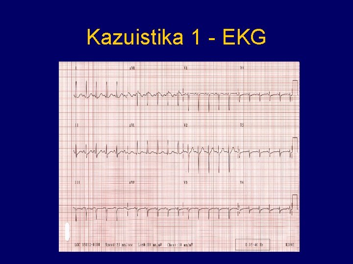 Kazuistika 1 - EKG 