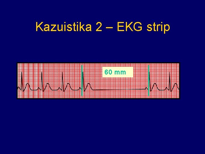 Kazuistika 2 – EKG strip 60 mm 