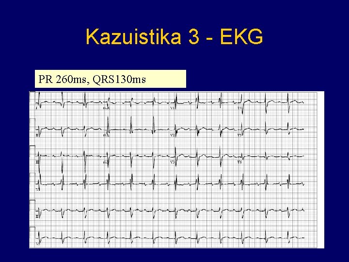 Kazuistika 3 - EKG PR 260 ms, QRS 130 ms 