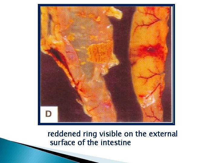 reddened ring visible on the external surface of the intestine 