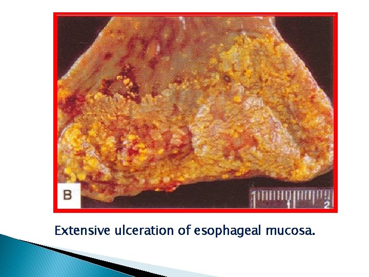 Extensive ulceration of esophageal mucosa. 