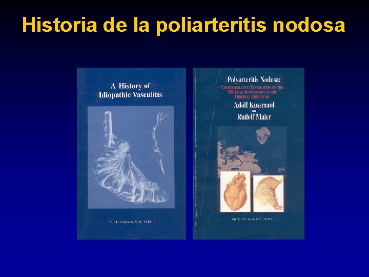 Historia de la poliarteritis nodosa 