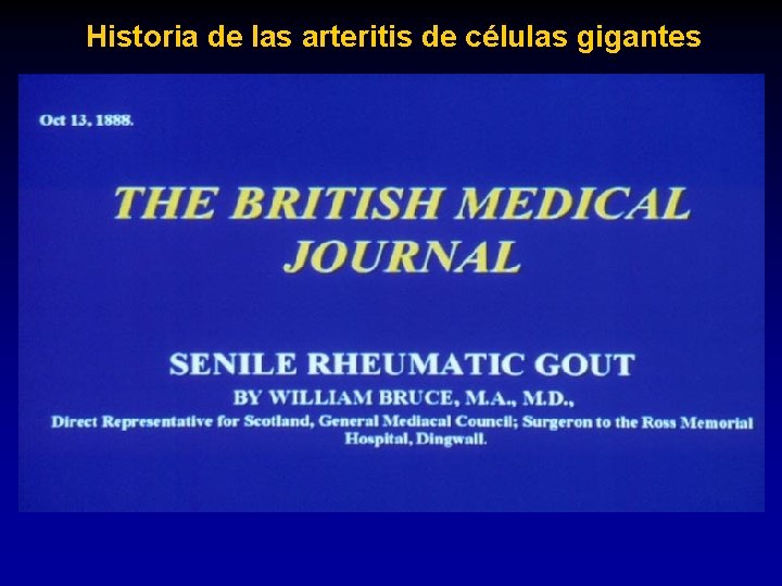 Historia de las arteritis de células gigantes 