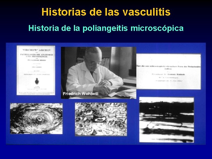 Historias de las vasculitis Historia de la poliangeitis microscópica Friedrich Wohlwill 