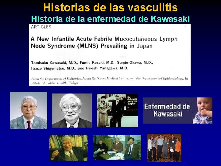Historias de las vasculitis Historia de la enfermedad de Kawasaki 