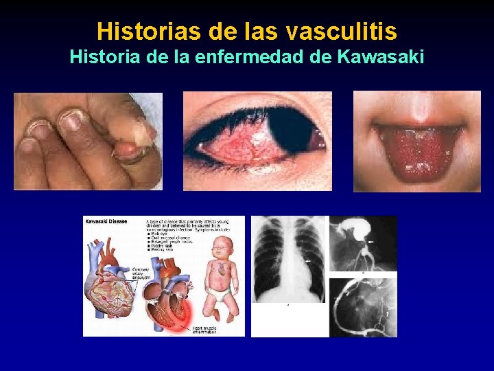 Historias de las vasculitis Historia de la enfermedad de Kawasaki 