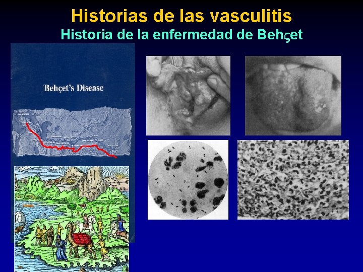 Historias de las vasculitis Historia de la enfermedad de Beh et 