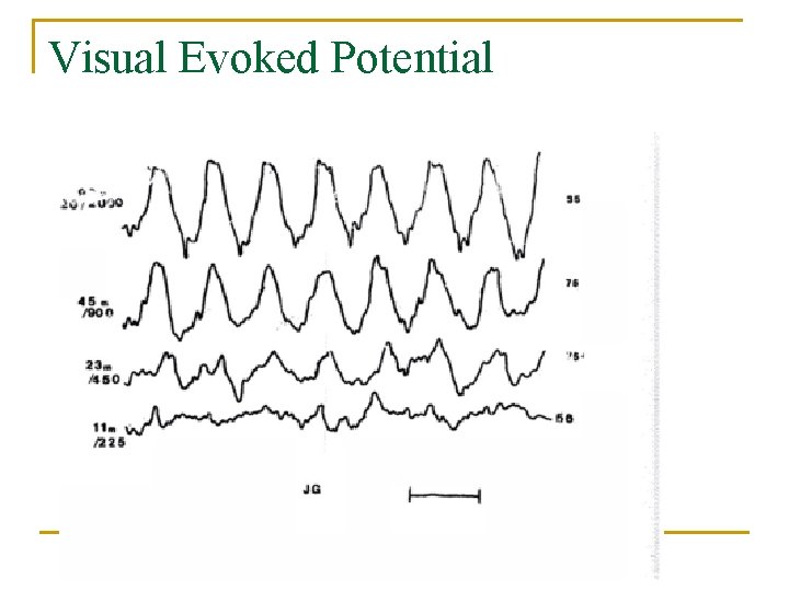 Visual Evoked Potential 