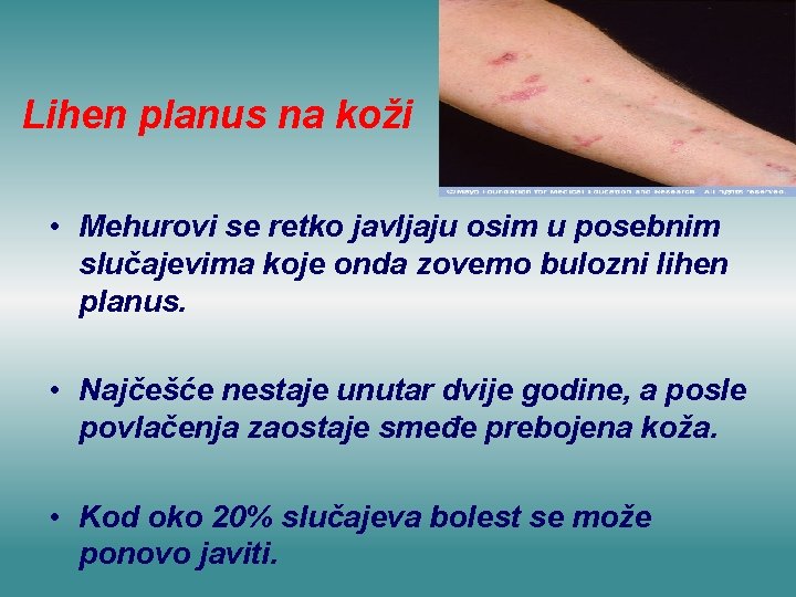 Lihen planus na koži • Mehurovi se retko javljaju osim u posebnim slučajevima koje