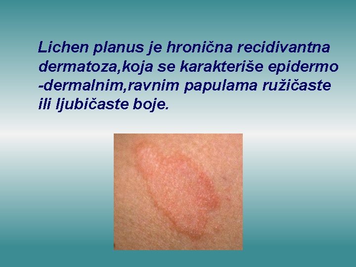 Lichen planus je hronična recidivantna dermatoza, koja se karakteriše epidermo -dermalnim, ravnim papulama ružičaste