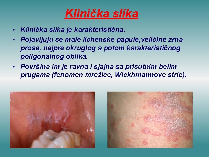 Klinička slika • Klinička slika je karakteristična. • Pojavljuju se male lichenske papule, veličine