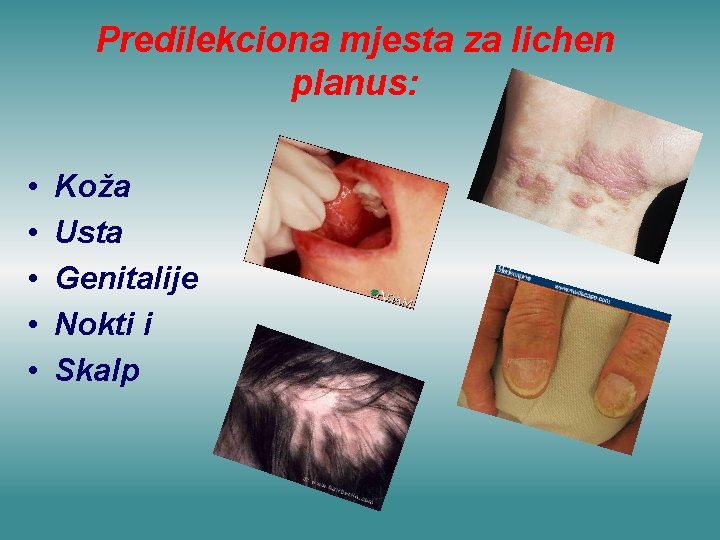 Predilekciona mjesta za lichen planus: • • • Koža Usta Genitalije Nokti i Skalp