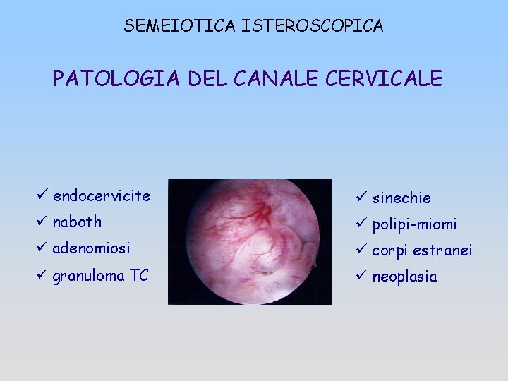 SEMEIOTICA ISTEROSCOPICA PATOLOGIA DEL CANALE CERVICALE ü endocervicite ü sinechie ü naboth ü polipi-miomi