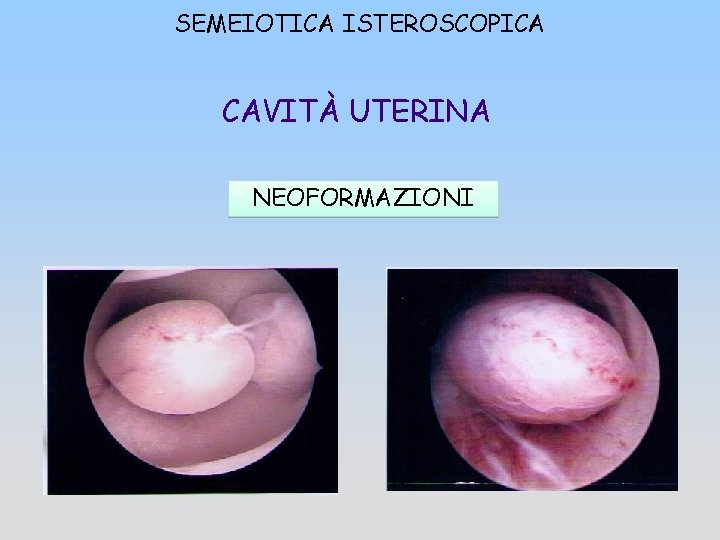 SEMEIOTICA ISTEROSCOPICA CAVITÀ UTERINA NEOFORMAZIONI 