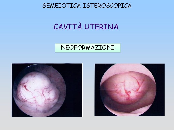 SEMEIOTICA ISTEROSCOPICA CAVITÀ UTERINA NEOFORMAZIONI 