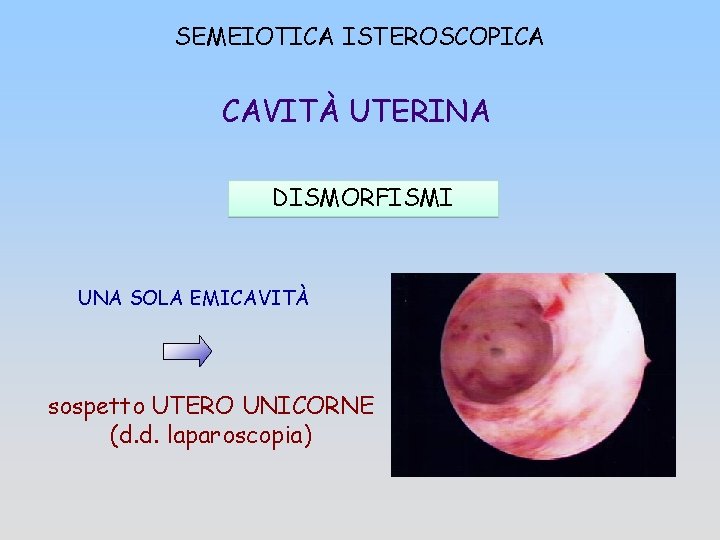 SEMEIOTICA ISTEROSCOPICA CAVITÀ UTERINA DISMORFISMI UNA SOLA EMICAVITÀ sospetto UTERO UNICORNE (d. d. laparoscopia)