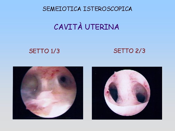 SEMEIOTICA ISTEROSCOPICA CAVITÀ UTERINA SETTO 1/3 SETTO 2/3 