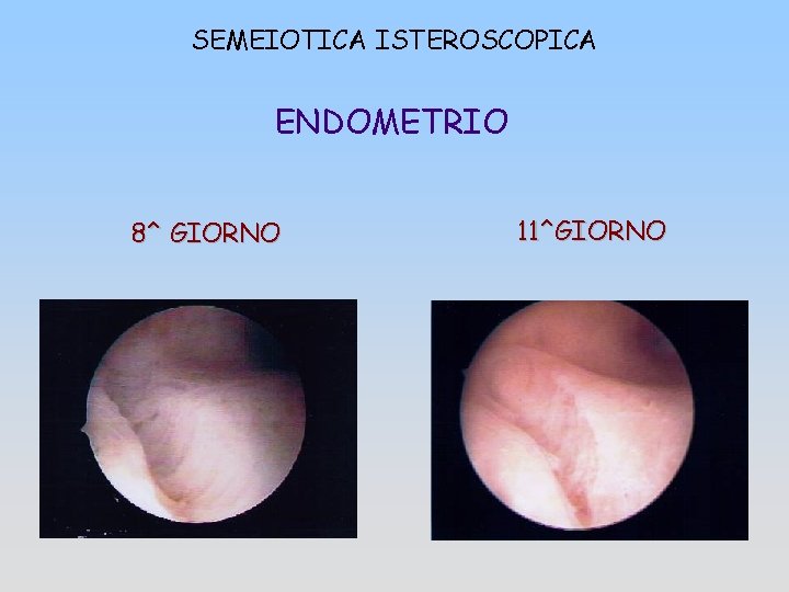 SEMEIOTICA ISTEROSCOPICA ENDOMETRIO 8^ GIORNO 11^GIORNO 