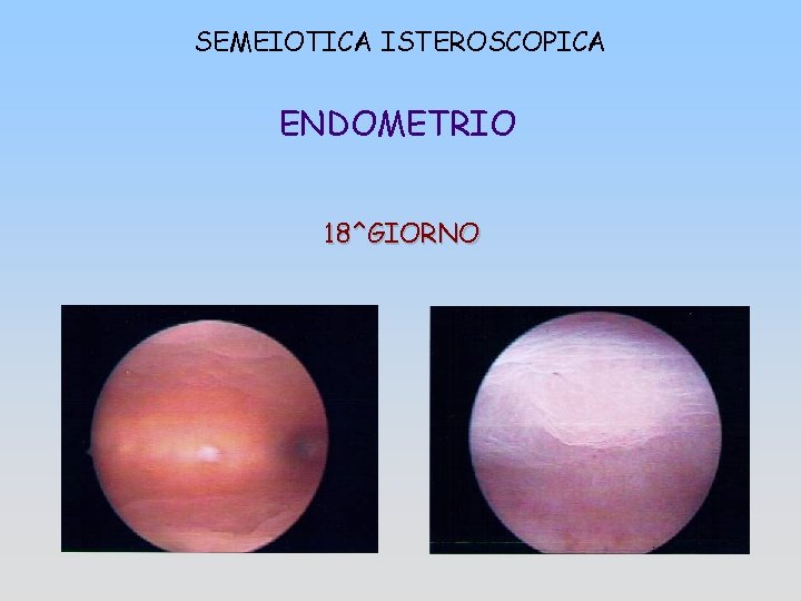 SEMEIOTICA ISTEROSCOPICA ENDOMETRIO 18^GIORNO 