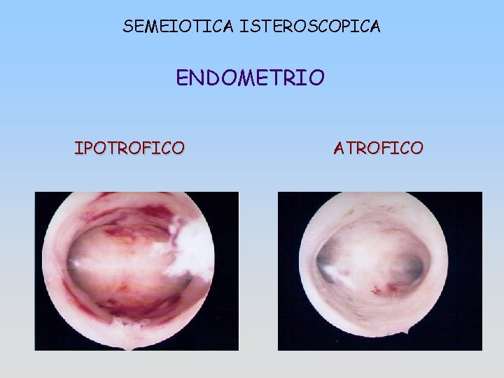 SEMEIOTICA ISTEROSCOPICA ENDOMETRIO IPOTROFICO ATROFICO 