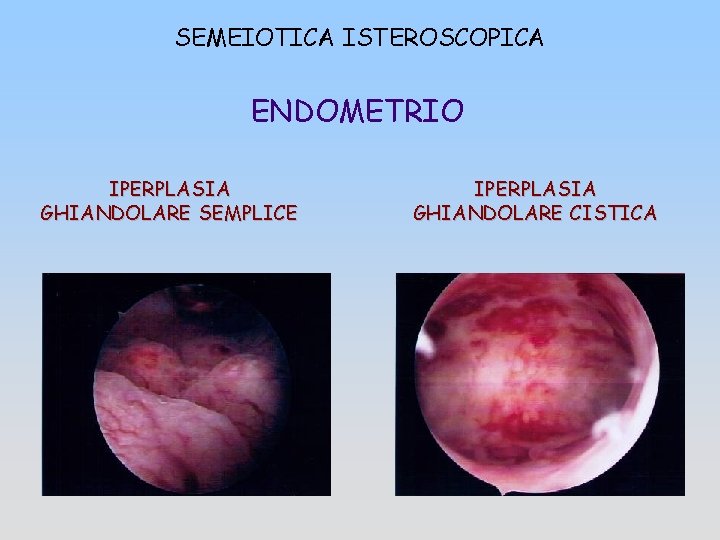 SEMEIOTICA ISTEROSCOPICA ENDOMETRIO IPERPLASIA GHIANDOLARE SEMPLICE IPERPLASIA GHIANDOLARE CISTICA 