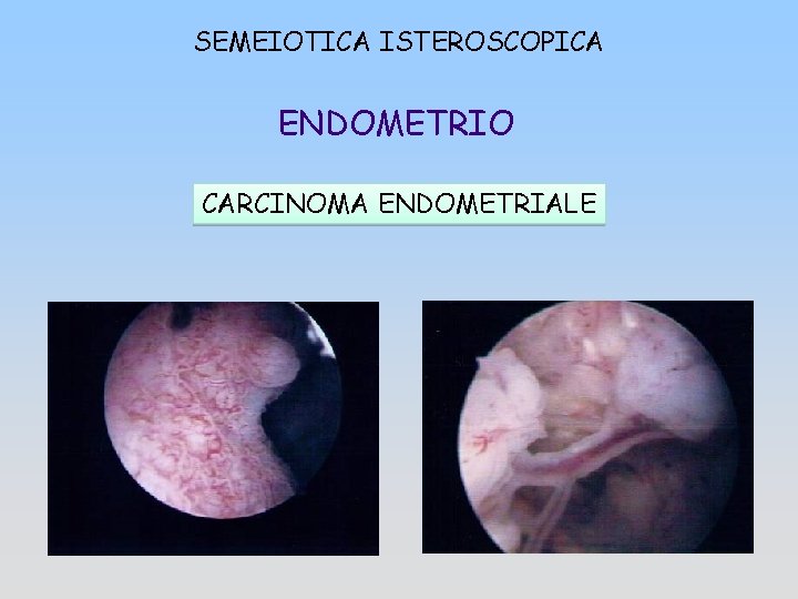 SEMEIOTICA ISTEROSCOPICA ENDOMETRIO CARCINOMA ENDOMETRIALE 