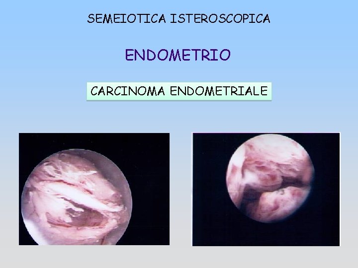 SEMEIOTICA ISTEROSCOPICA ENDOMETRIO CARCINOMA ENDOMETRIALE 
