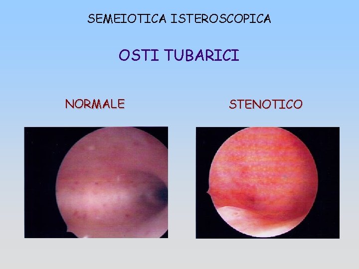 SEMEIOTICA ISTEROSCOPICA OSTI TUBARICI NORMALE STENOTICO 