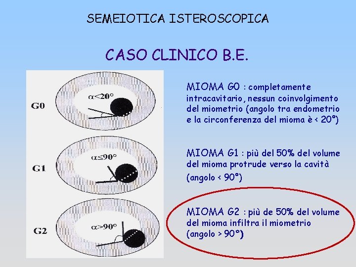 SEMEIOTICA ISTEROSCOPICA CASO CLINICO B. E. MIOMA G 0 : completamente intracavitario, nessun coinvolgimento