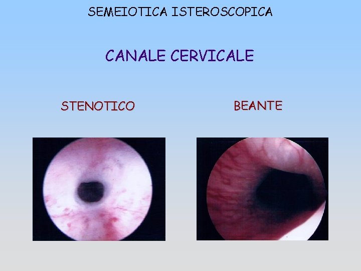 SEMEIOTICA ISTEROSCOPICA CANALE CERVICALE STENOTICO BEANTE 