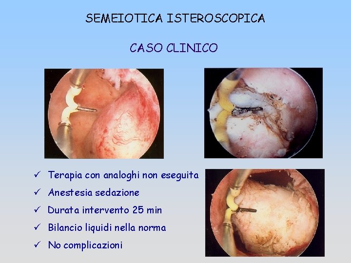 SEMEIOTICA ISTEROSCOPICA CASO CLINICO ü Terapia con analoghi non eseguita ü Anestesia sedazione ü