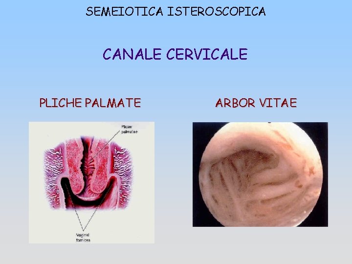 SEMEIOTICA ISTEROSCOPICA CANALE CERVICALE PLICHE PALMATE ARBOR VITAE 