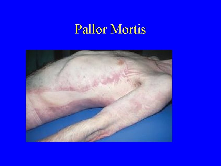 Pallor Mortis Pallor Mortis