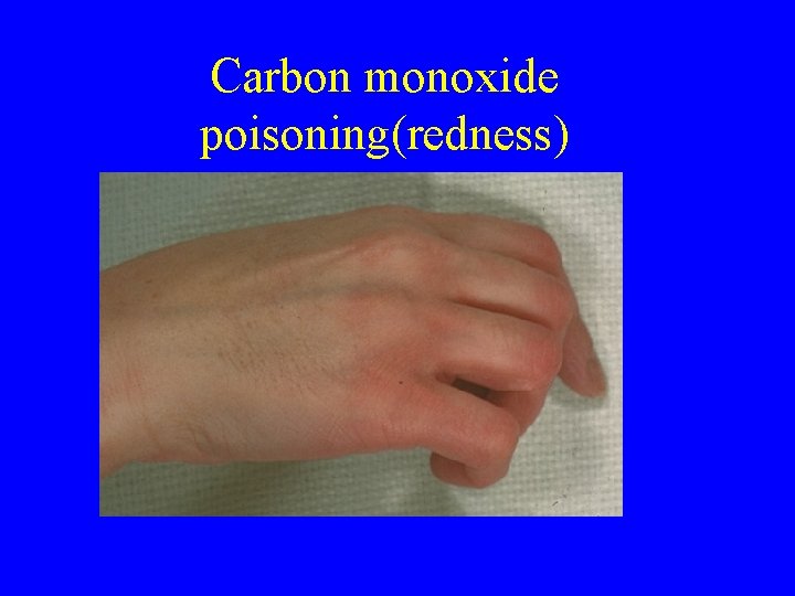 Carbon monoxide poisoning(redness) Carbon monoxide poisoning(redness)