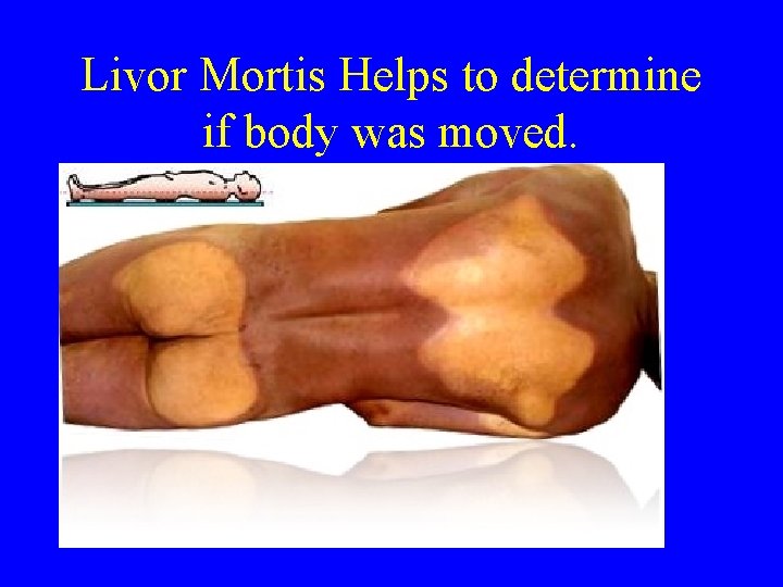 Livor Mortis Helps to determine if body was moved. Livor Mortis Helps to determine if body was moved.
